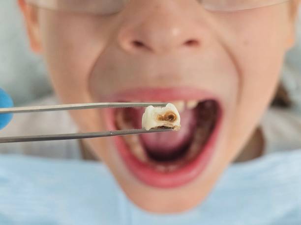 Best Emergency Tooth Extraction in San Fernando, CA